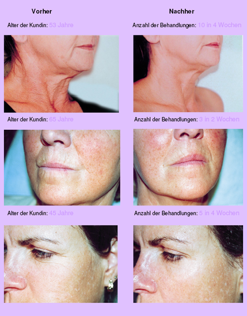 Before_and_after_Nora _Bode_OXYjet_treatment